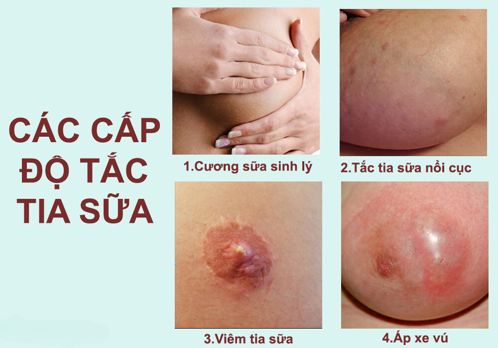 các cấp độ tắc tia sữa