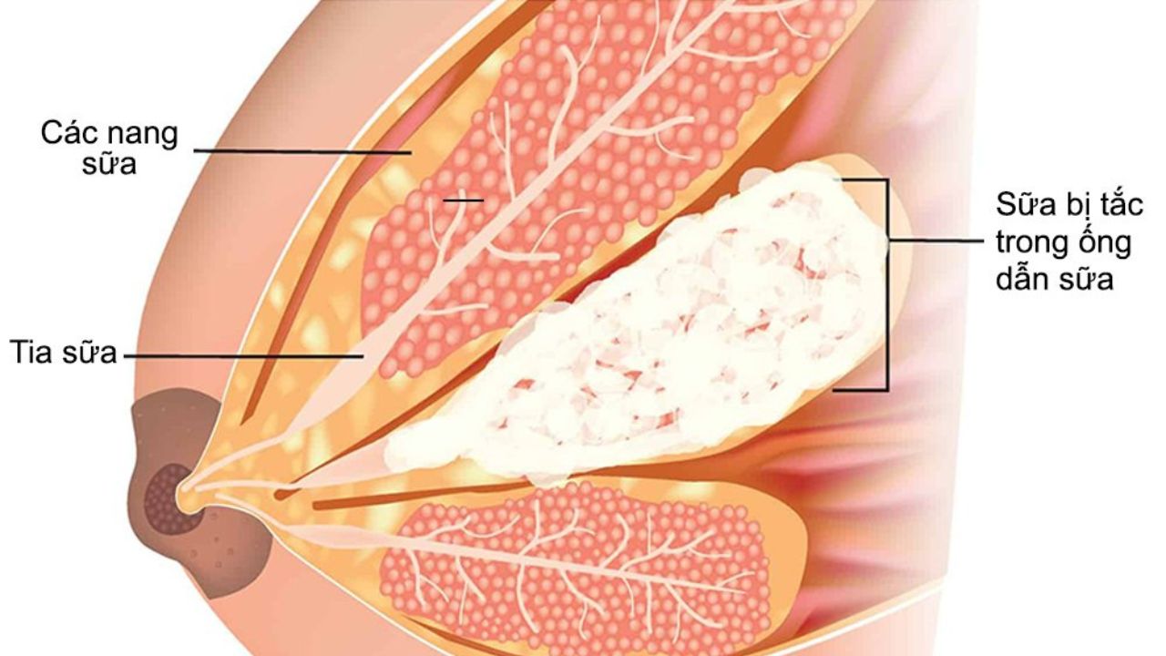 dấu hiệu nhận biết tắc tia sữa