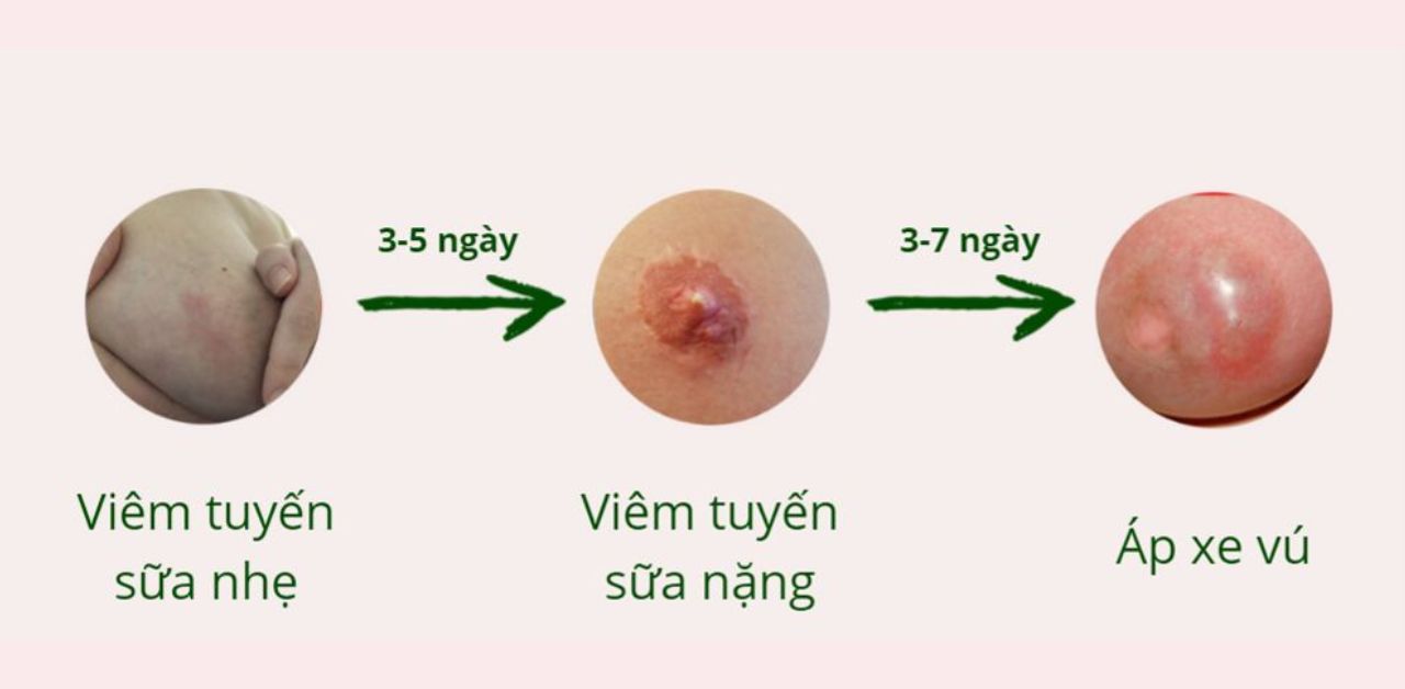 hậu quả nghiêm trọng của tắc tia sữa