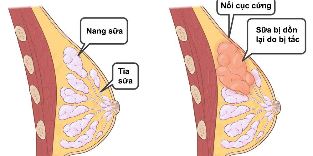 tắc tia sữa nổi cục nhưng không đau