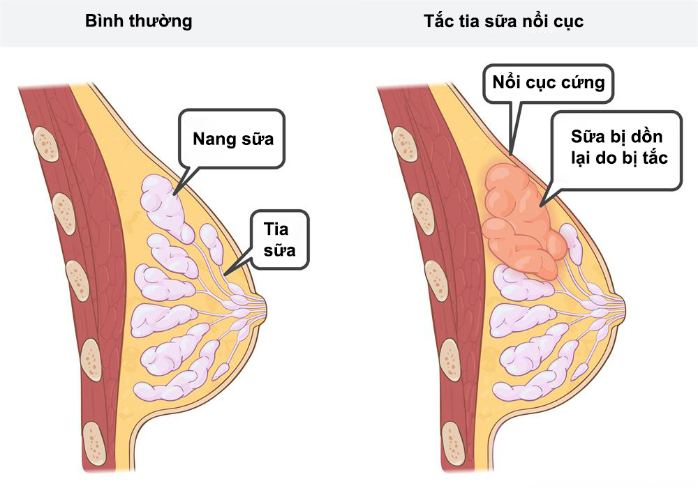 tắc tia sữa nổi cục nhưng không đau