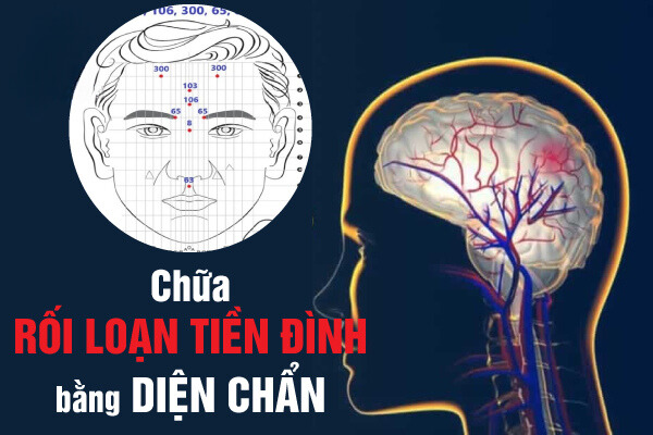 điều trị rối loạn tiền đình bằng diện chẩn