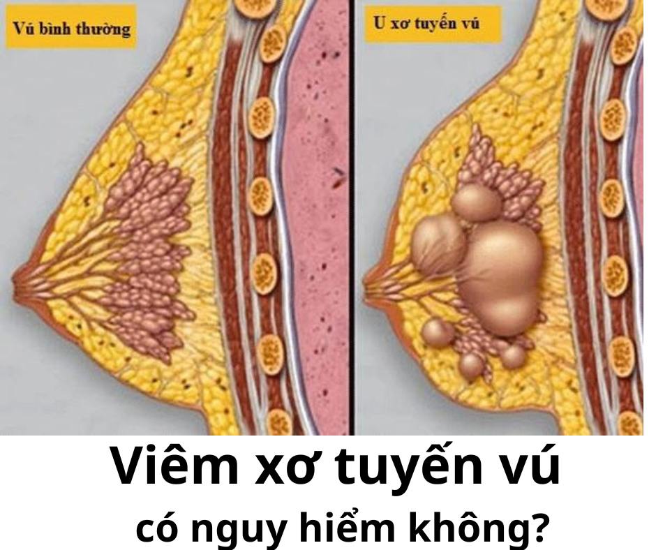 viêm xơ tuyến vú có nguy hiểm không